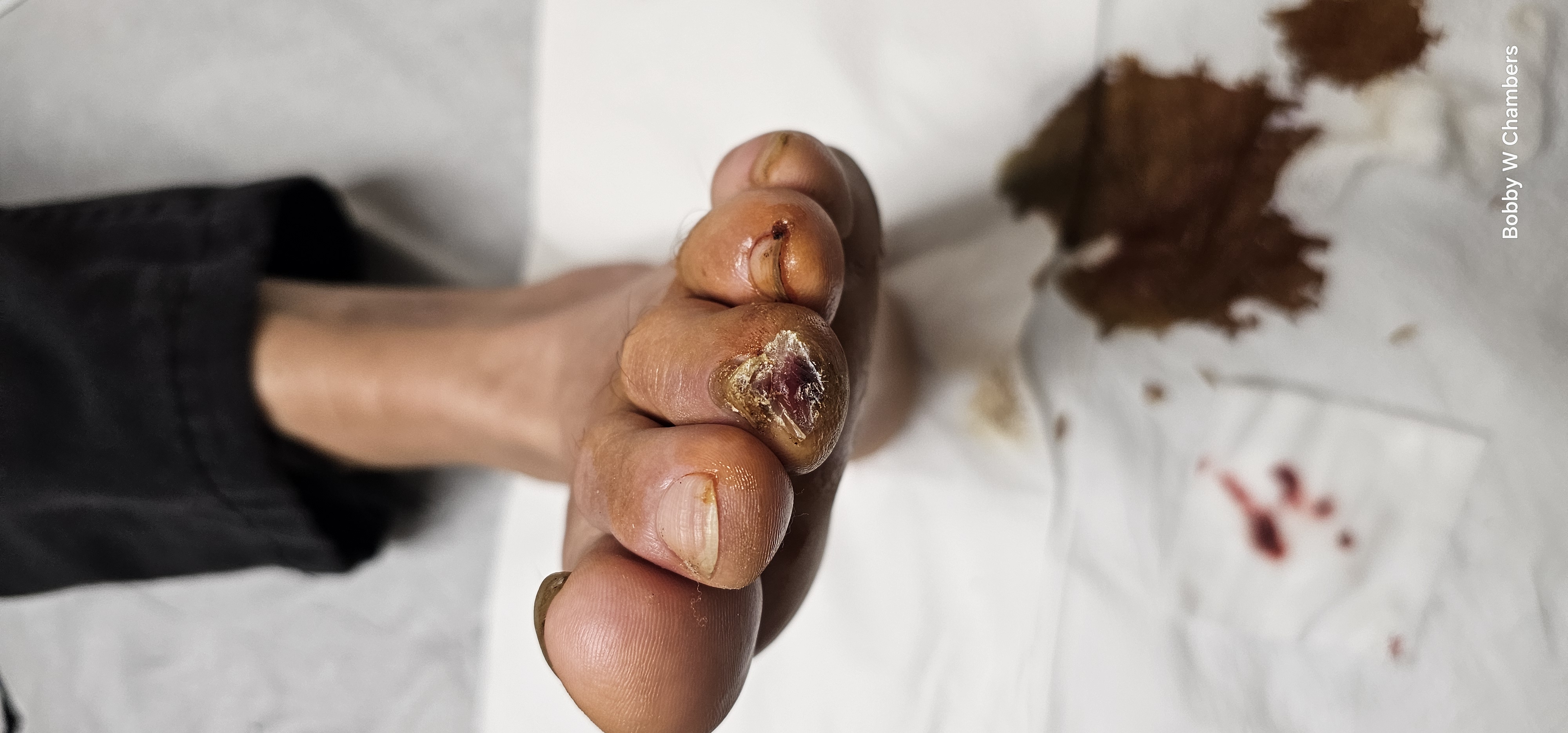 Lonnie's toes - damage from living on the street